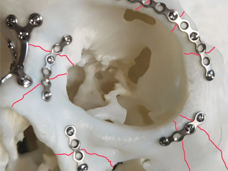Craniomaxillofacial Applications-1